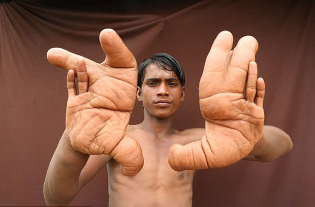 Cậu bé bị dân làng gọi là "quỷ dữ" vì đôi tay to bất thường